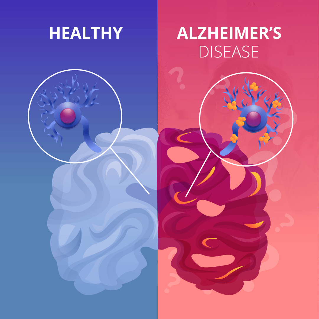 alzheimerova choroba 4